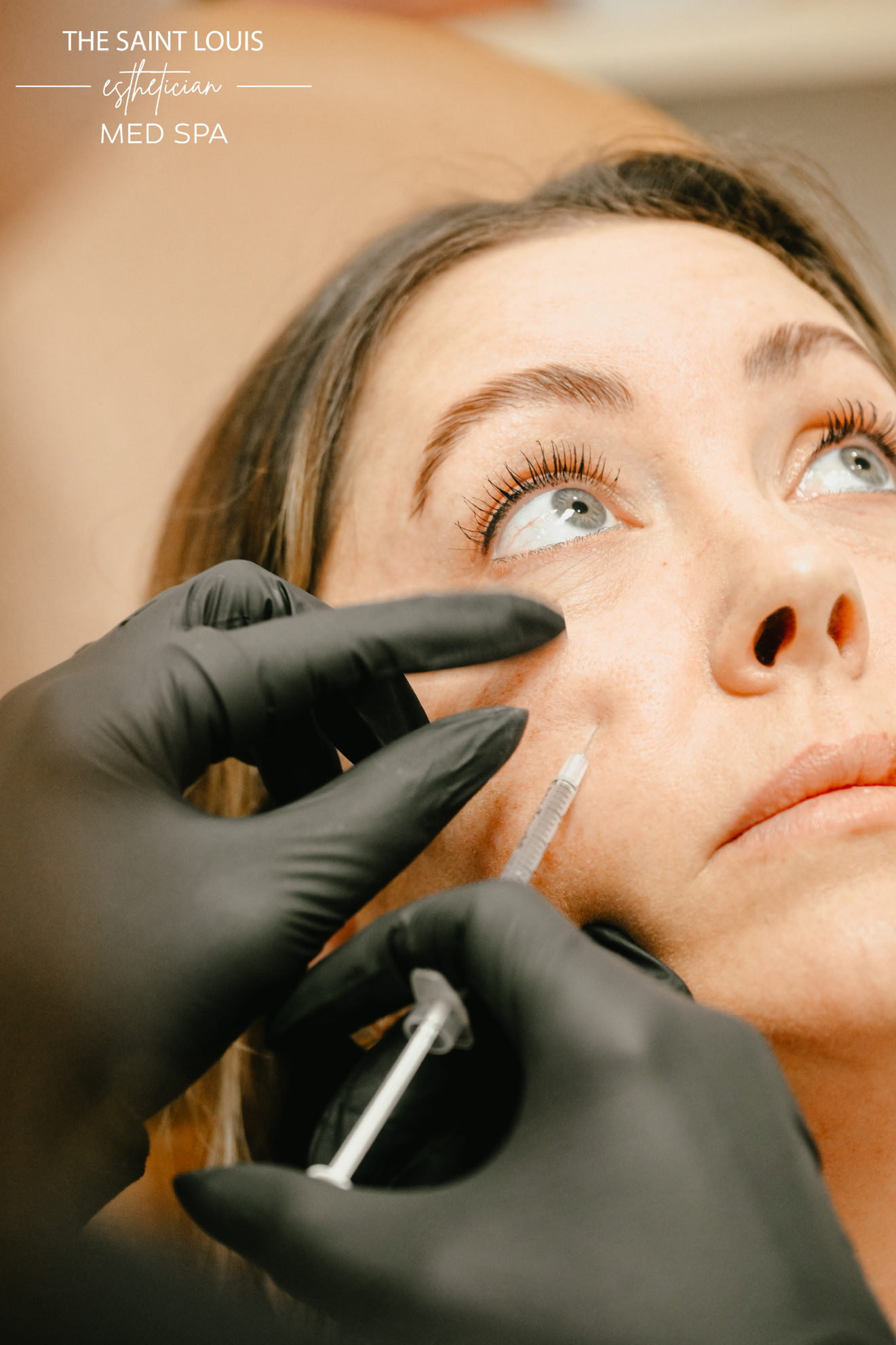 Cheek Filler Dermal Filler - 1 Syringe