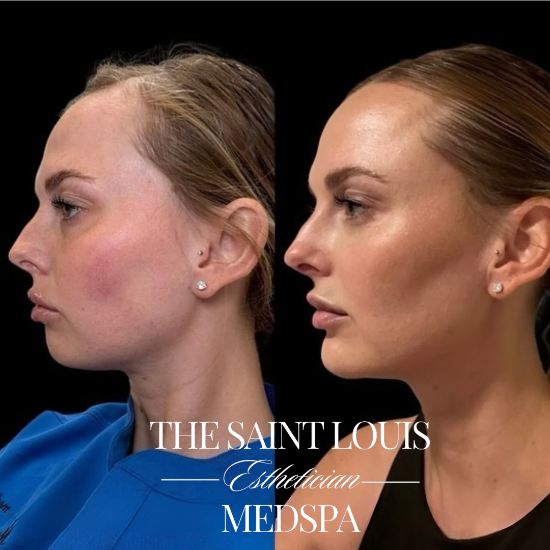 Saint Louis, Missouri Full Face Rebalancing Filler Injections