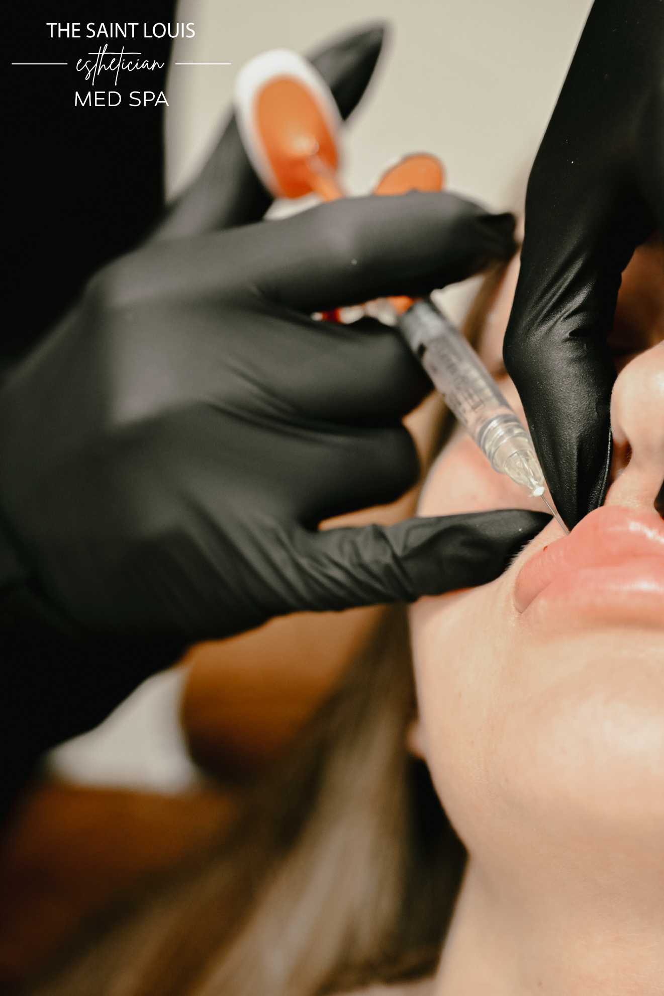 Lip Filler Dermal Filler - 1 Syringe