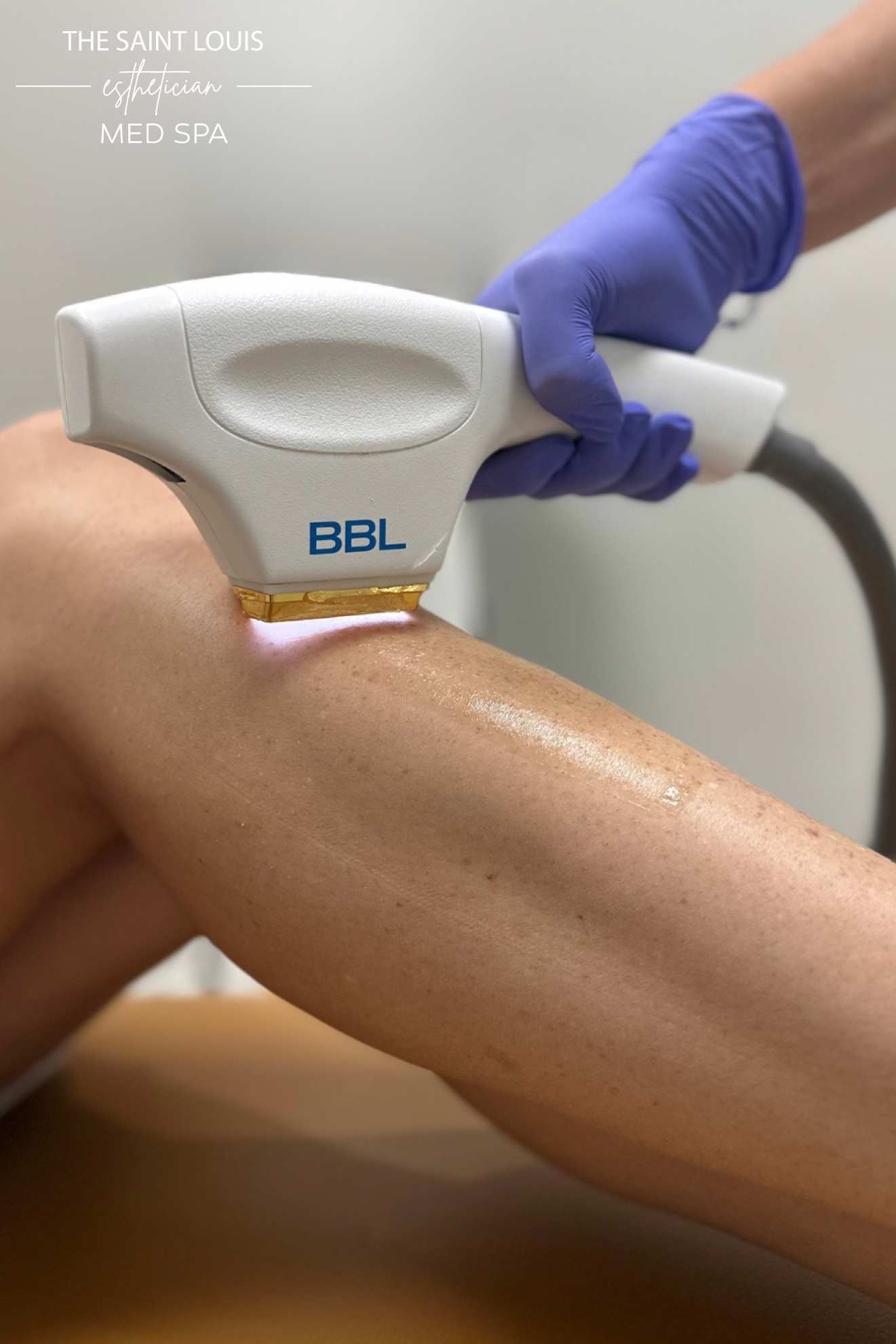 Laser Hair Removal - 1 Session
