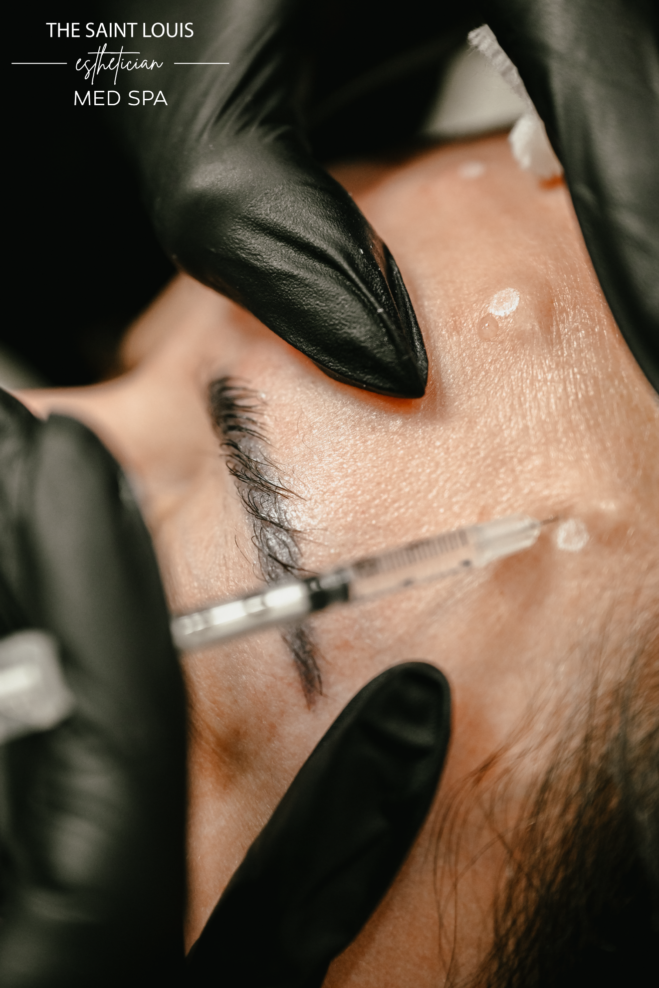 Botox Neurotoxin Injections - 50 Units