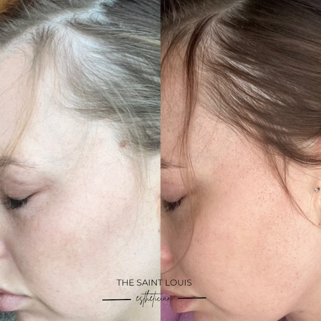 Saint Louis, Missouri PRP and PRFM Hair Restoration