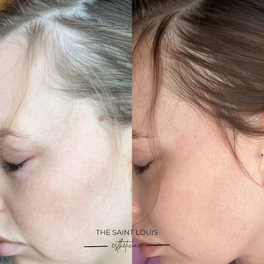 Saint Louis, Missouri PRP and PRFM Hair Restoration