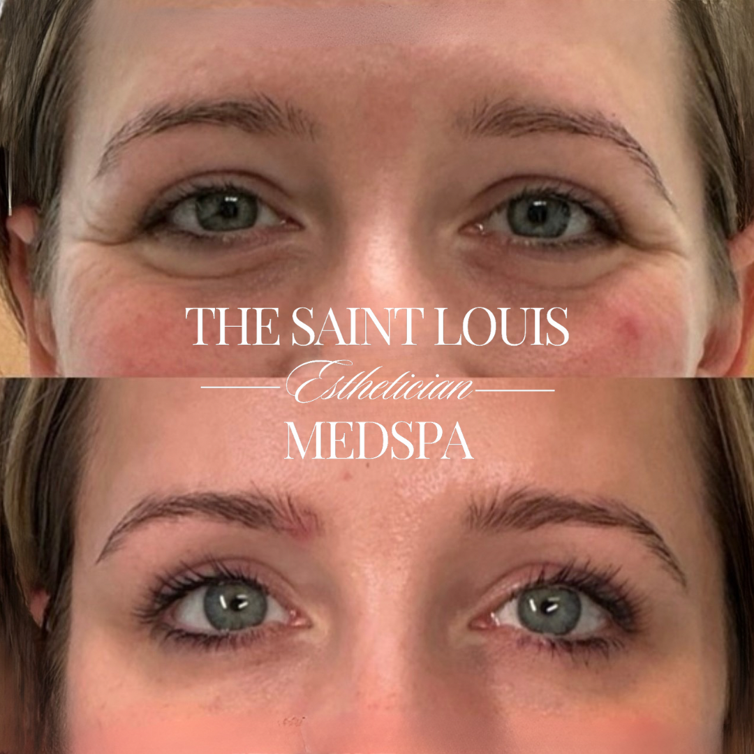 Saint Louis, Missouri PRP and PRFM Under Eye Filler Injection