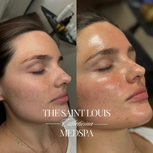 St. Louis, Missouri The Dermaplane Facial The Saint Louis Med Spa