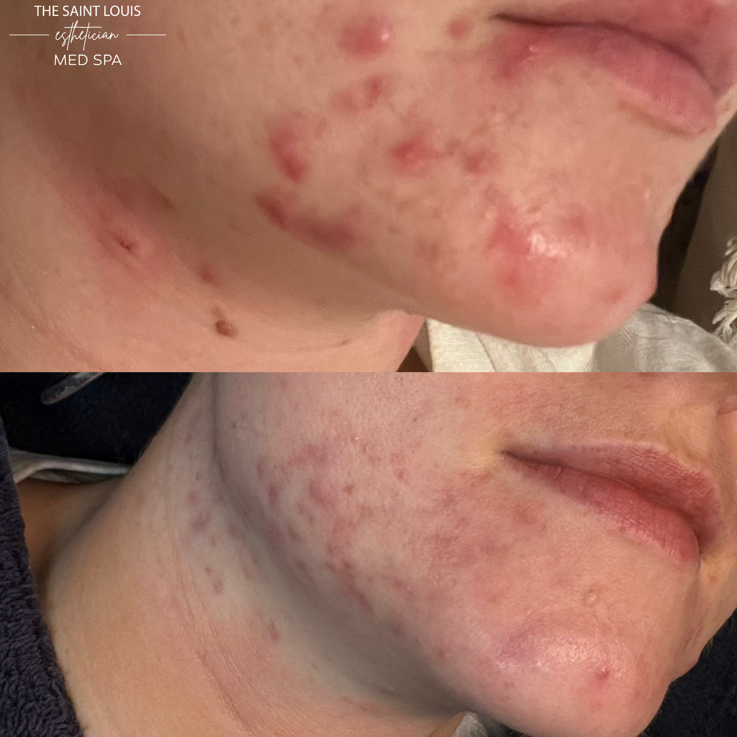 Open House Special - Acne Bootcamp (3) BBL Forever Clear, (3) Acne Facials or Peels