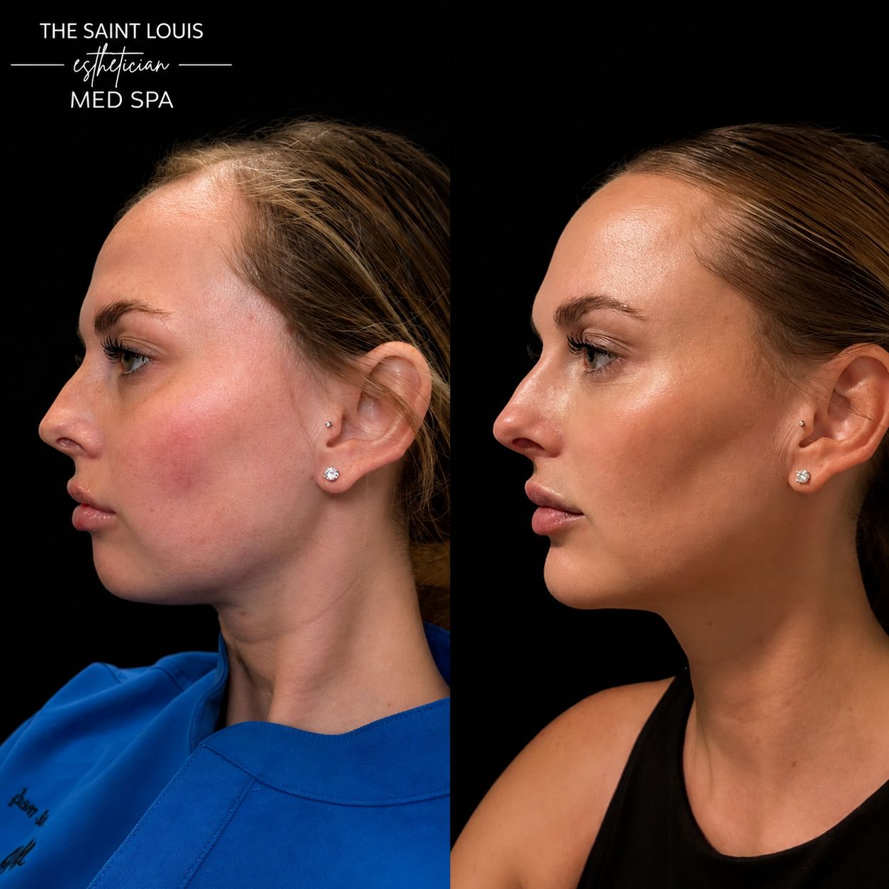 2026 Open House Special - Buy 2 Syringes of Filler Get One Free