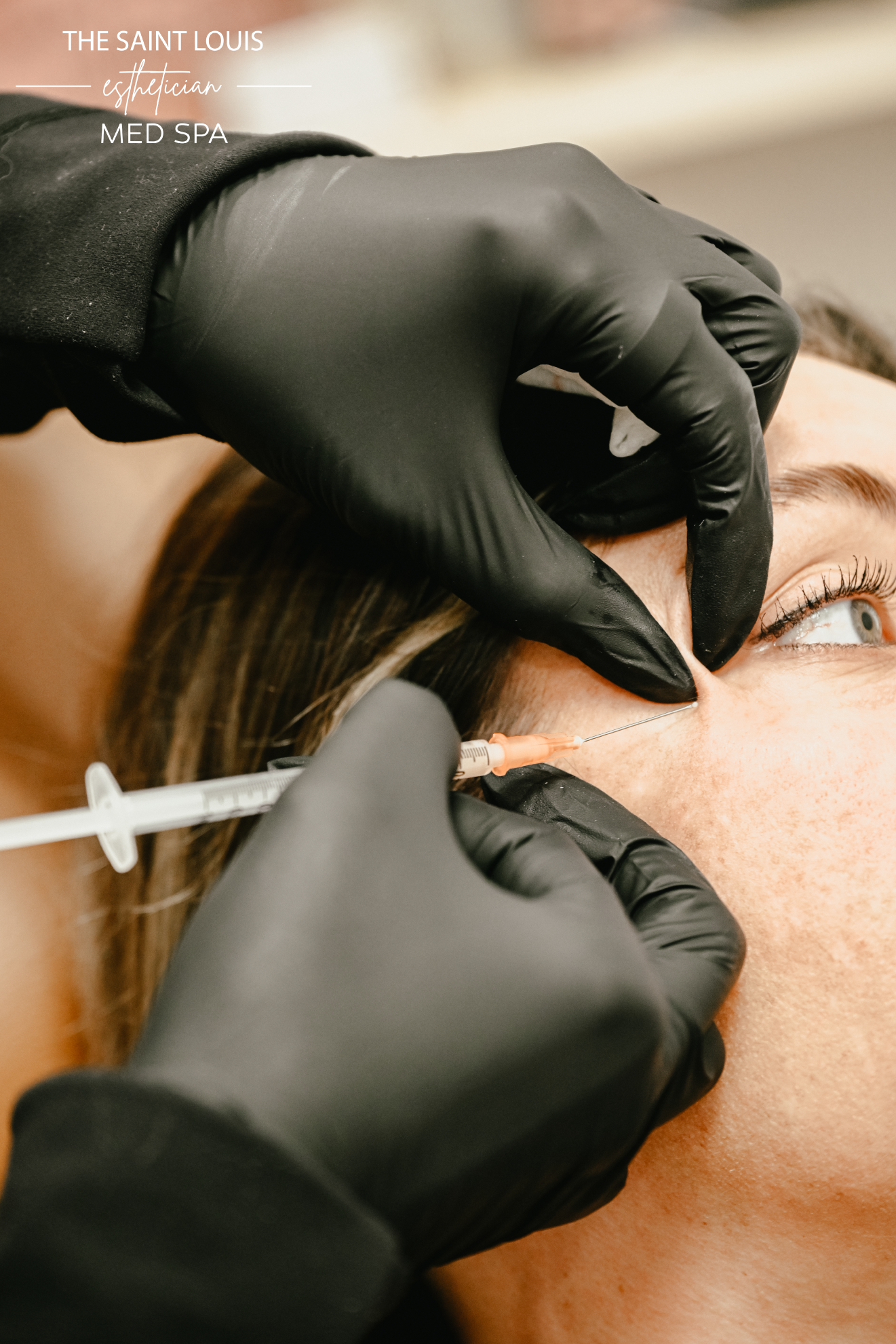 Cheek Filler Dermal Filler - 1 Syringe