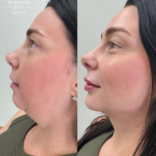 2026 Open House Special - Full Facial Rebalancing (5 Syringes, One Session)