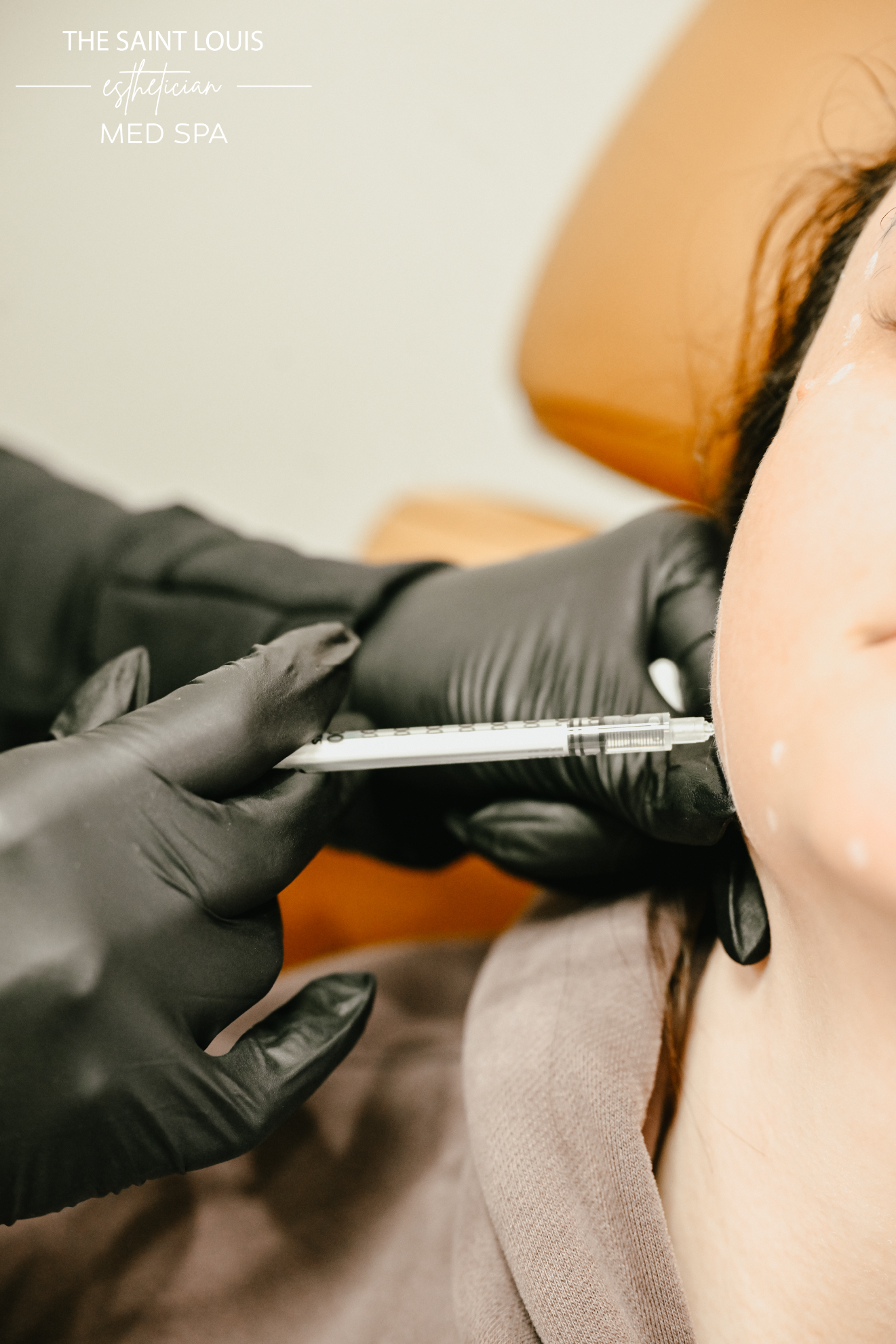 Jawline Dermal Filler - 1 Syringe