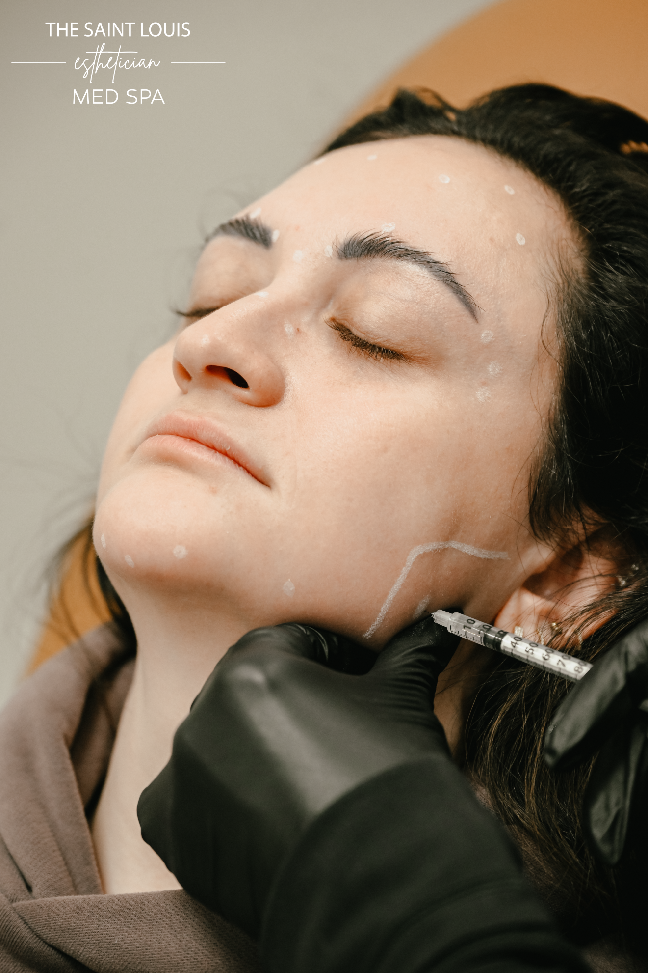 Jawline Dermal Filler - 1 Syringe