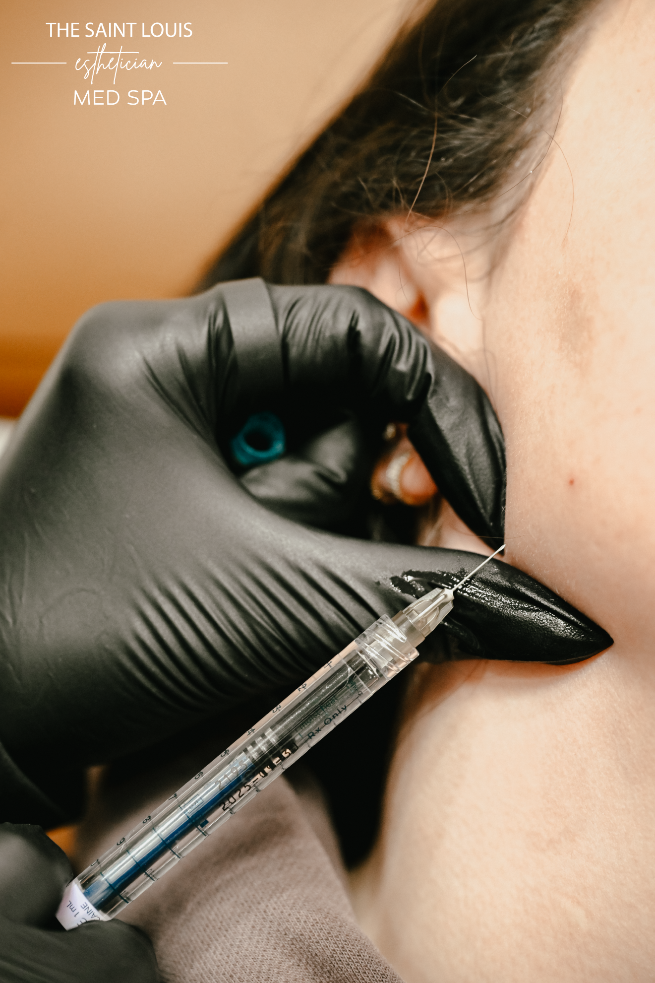 Jawline Dermal Filler - 1 Syringe