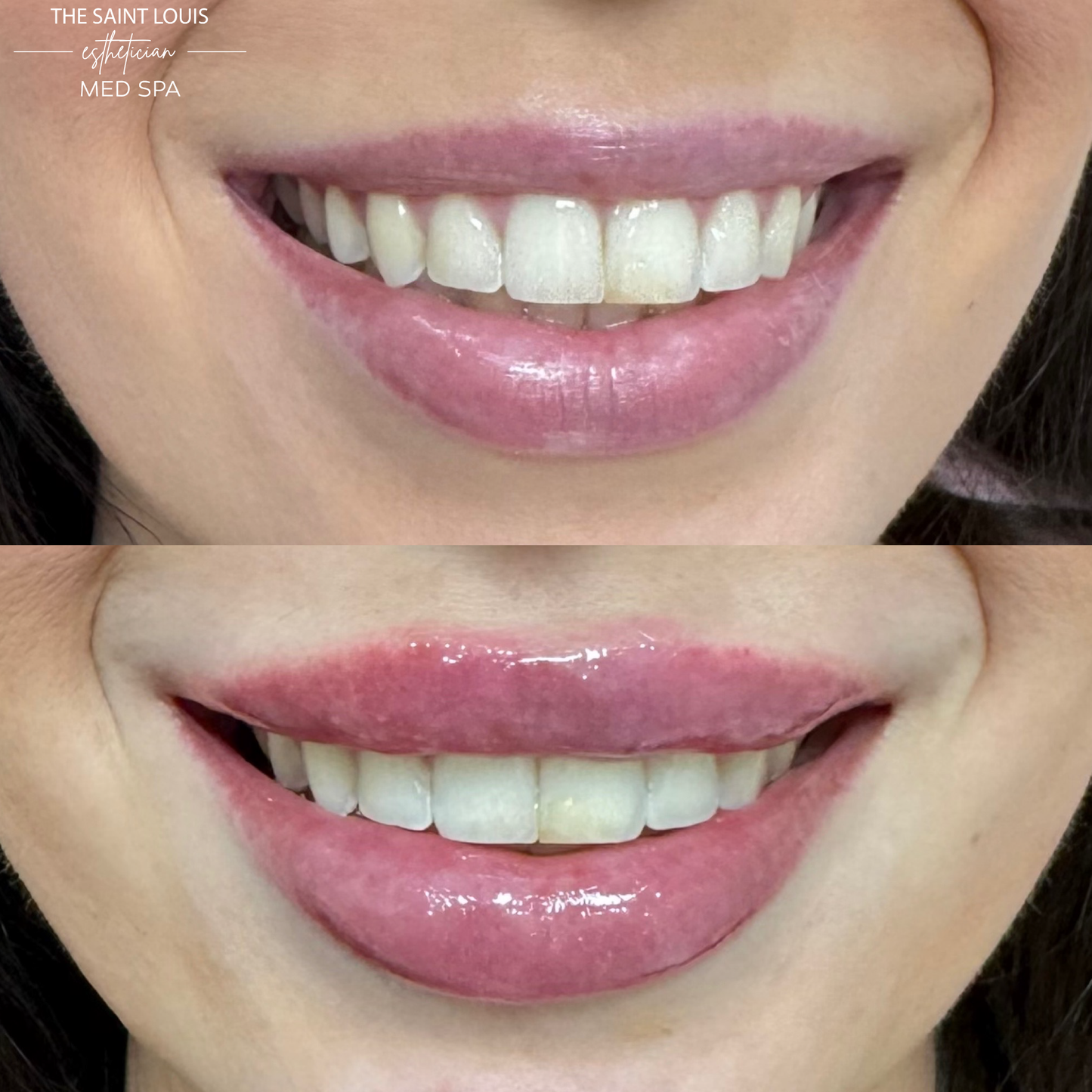 Open House Special - Lip Filler (One Syringe) for $599