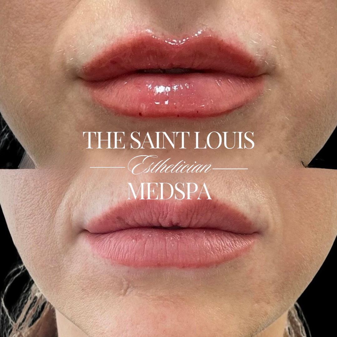 Saint Louis, Missouri Lip Filler Special