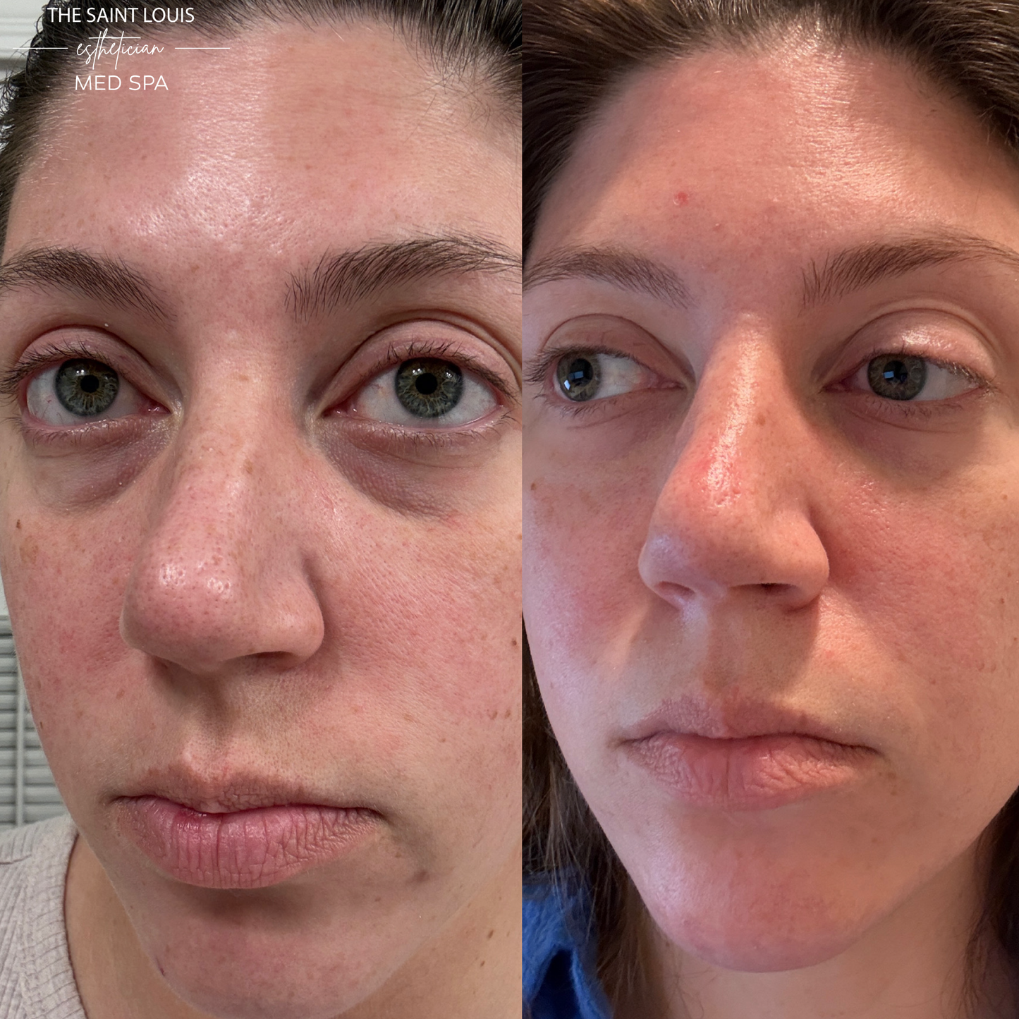 Open House Special - PRFM Undereye Treatment