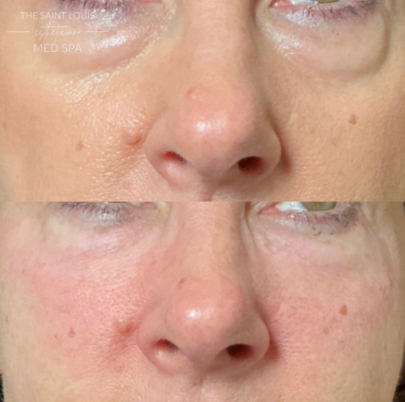 2026 Open House Special - PRFM Undereye Treatment