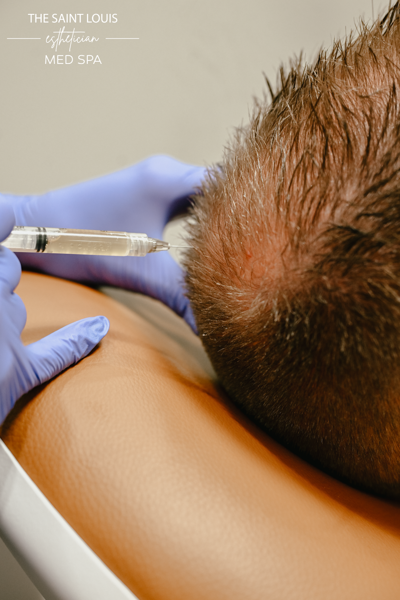 Platelet Rich Fibrin Matrix (PRFM) Hair Restoration - 1 Session