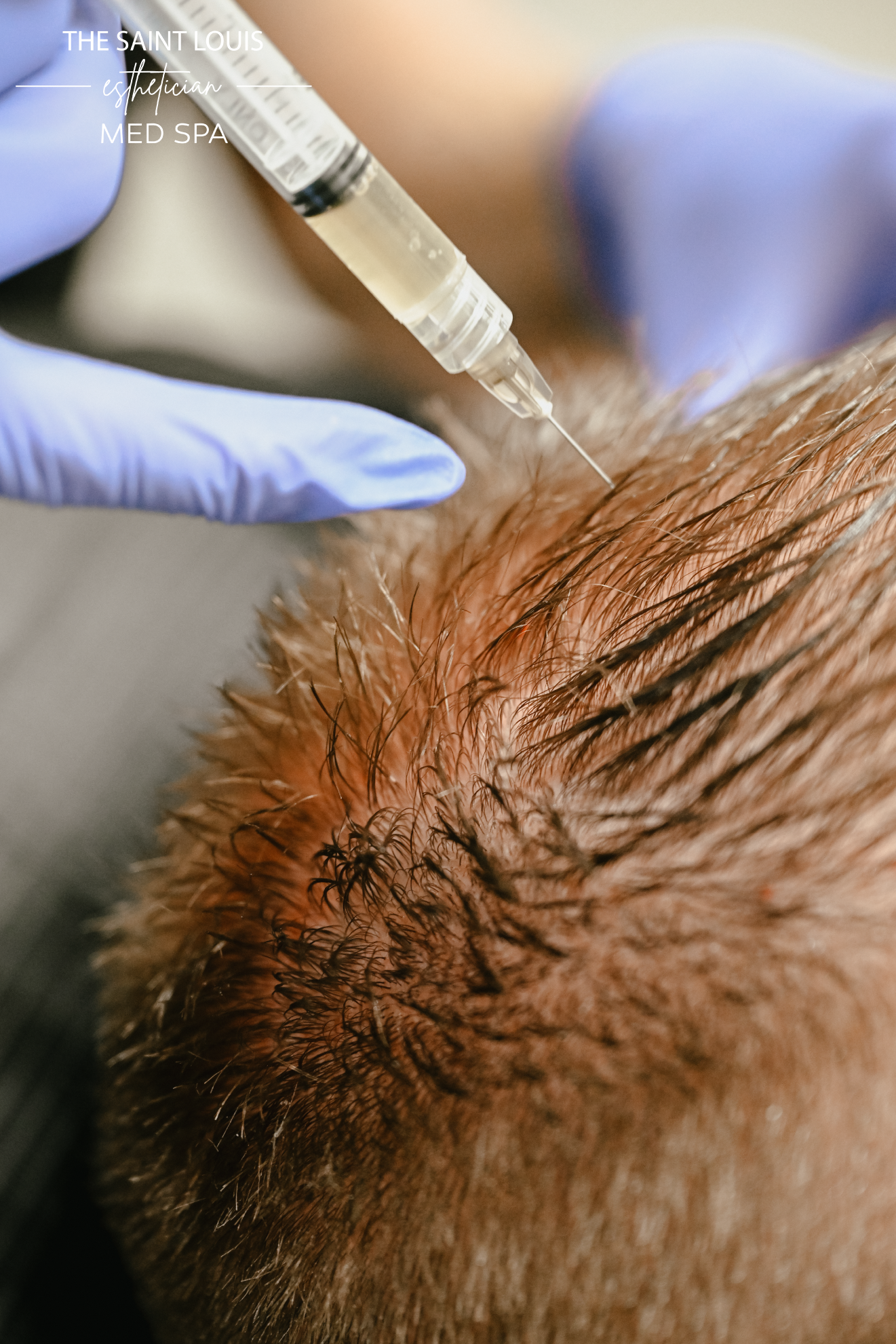 Platelet Rich Fibrin Matrix (PRFM) Hair Restoration - 1 Session