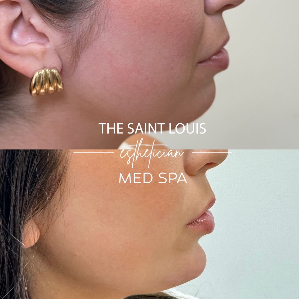 Contour Injection Restylane Contour Dermal Filler Injection in St. Louis, MO – The Saint ...
