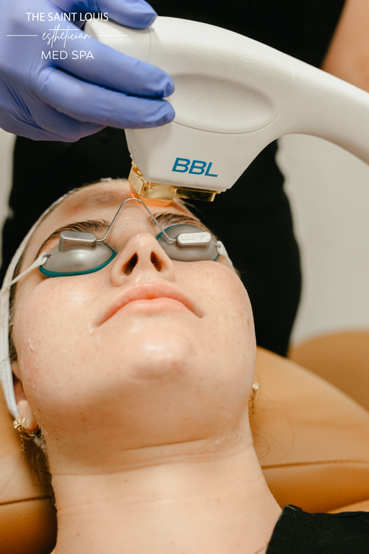 Broadband Light (BBL) Laser Face Treatment - 1 Session