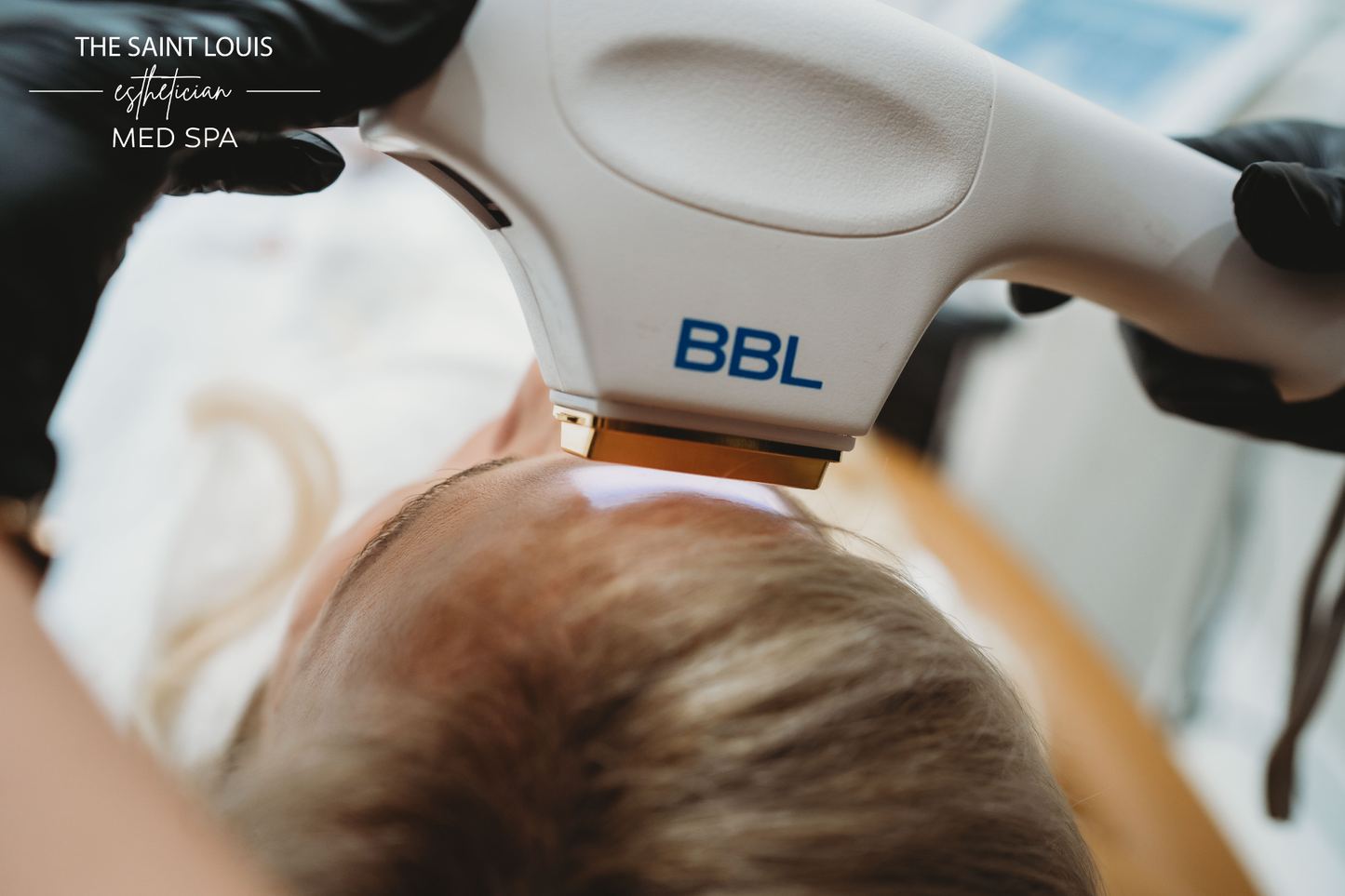 Moxi + BBL Laser Face Treatment - 1 Session