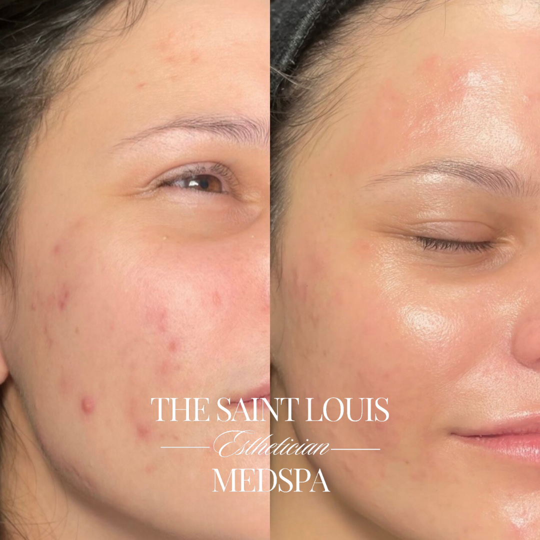 St. Louis, Missouri The Acne Facial The Saint Louis Med Spa