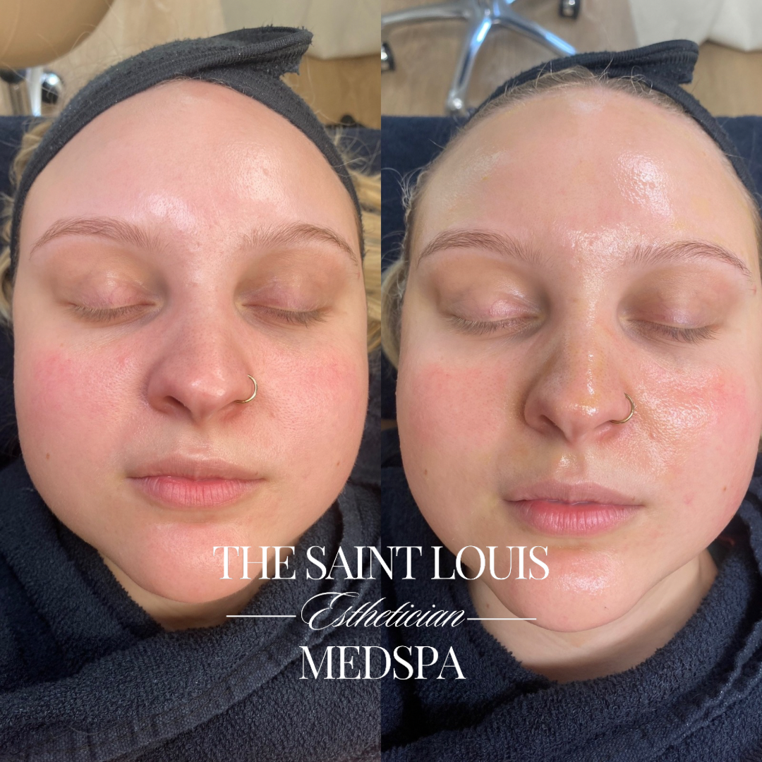 St. Louis, Missouri The Anti-Aging Facial The Saint Louis Med Spa