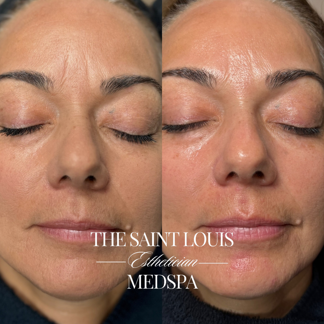 St. Louis, Missouri The Hydrating Facial The Saint Louis Med Spa