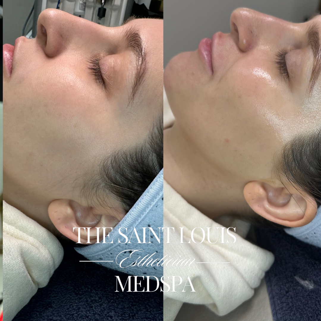 St. Louis, MO The Lunch Time Facial The Saint Louis Med Spa