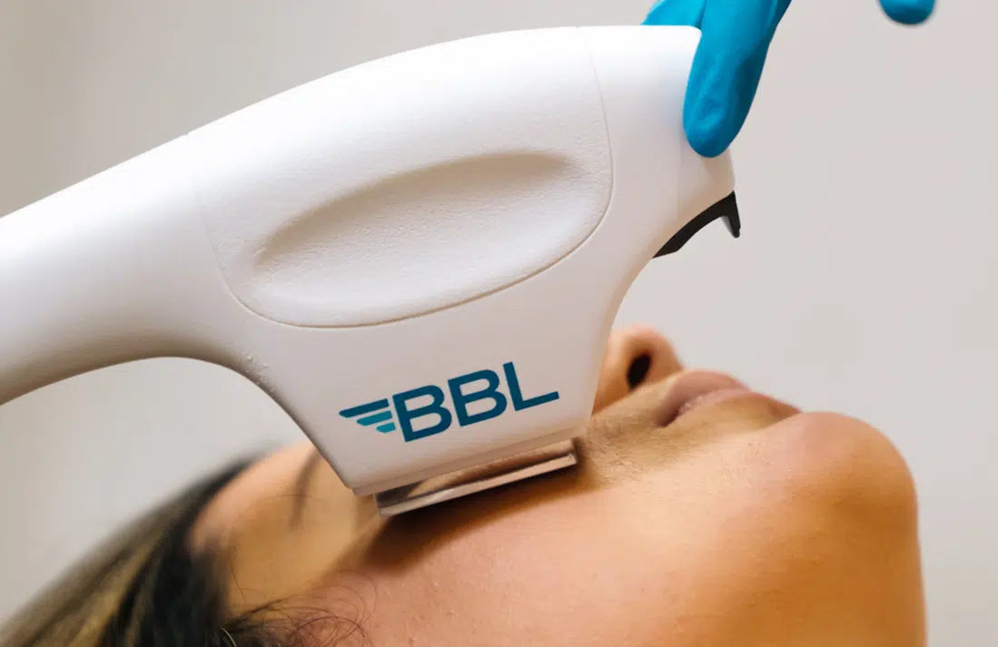 BBL Face Laser (3 Session)